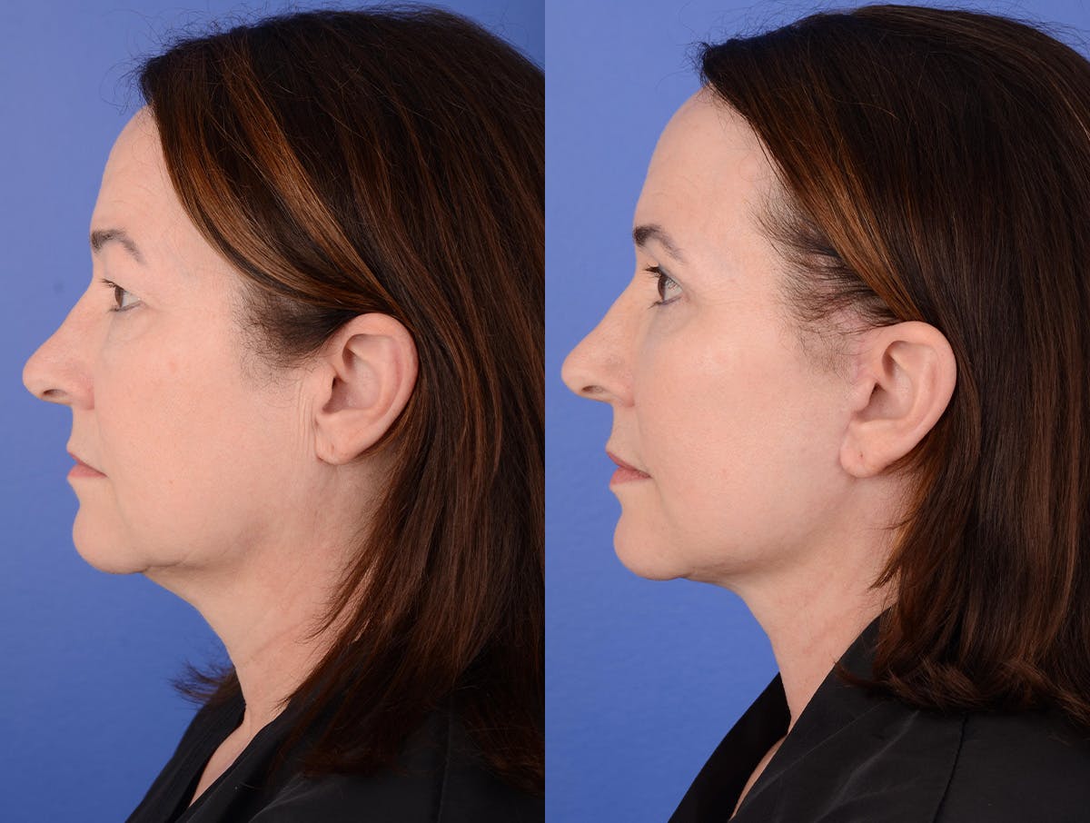 Facelift Before & After Gallery - Patient 341595 - Image 3