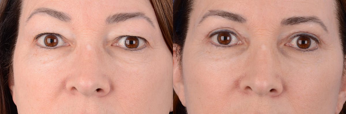 Blepharoplasty Before & After Gallery - Patient 177087 - Image 1