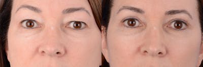 Blepharoplasty Before & After Gallery - Patient 177087 - Image 1