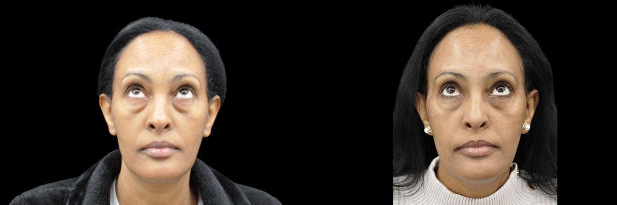 Blepharoplasty (Eyelid Surgery) Before & After Gallery - Patient 990694 - Image 2