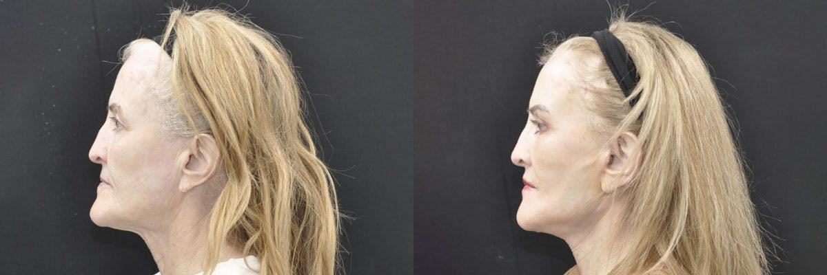 Facelift Before & After Gallery - Patient 259851 - Image 2
