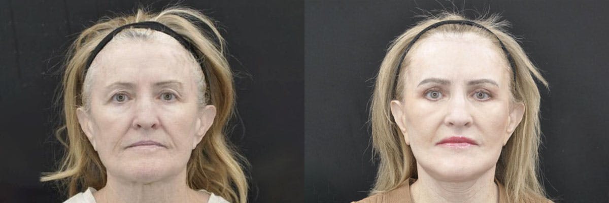 Facelift Before & After Gallery - Patient 259851 - Image 3