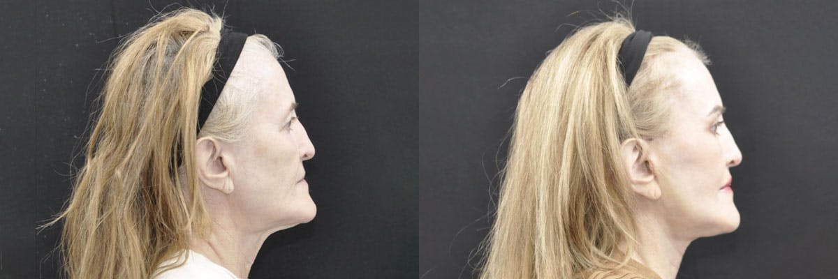 Facelift Before & After Gallery - Patient 259851 - Image 4