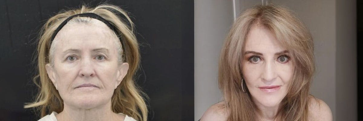 Facelift Before & After Gallery - Patient 259851 - Image 1