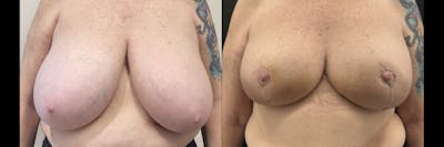 Breast Reduction Before & After Gallery - Patient 168470 - Image 1