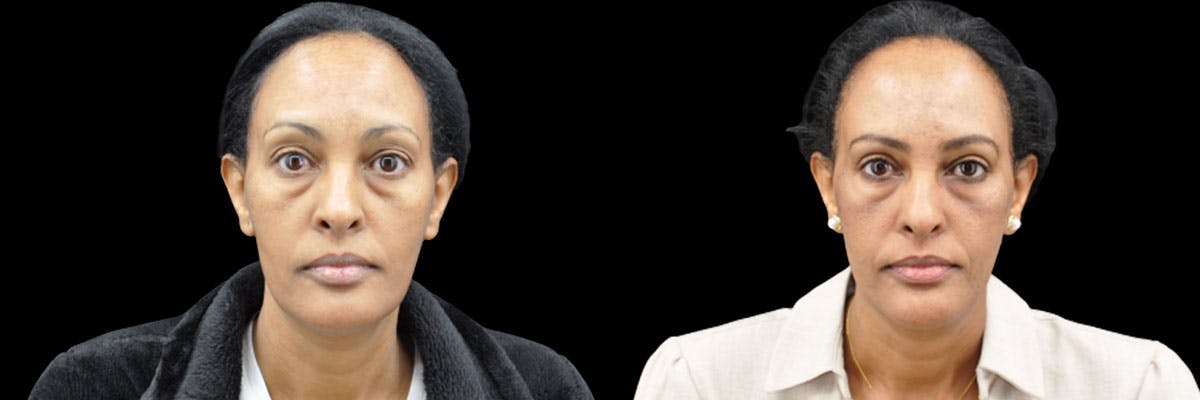 Blepharoplasty (Eyelid Surgery) Before & After Gallery - Patient 990694 - Image 1