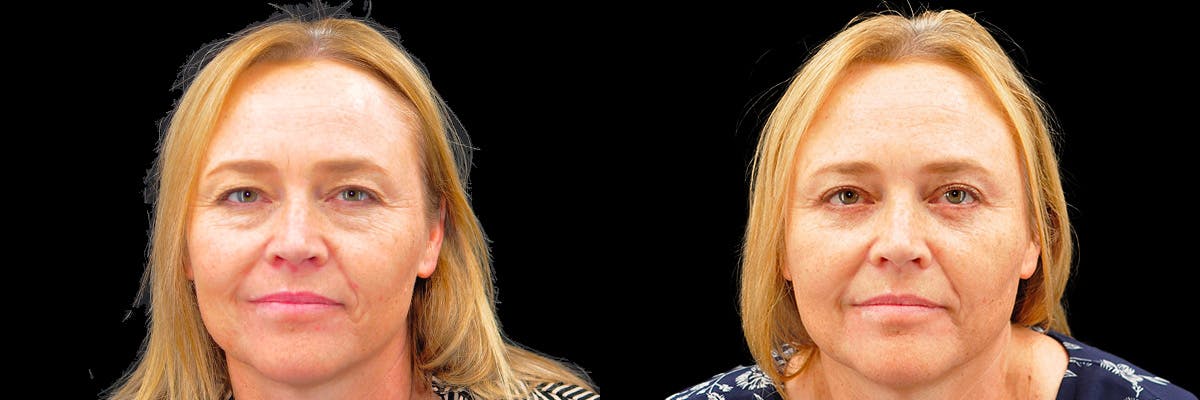 Blepharoplasty (Eyelid Surgery) Before & After Gallery - Patient 889458 - Image 1