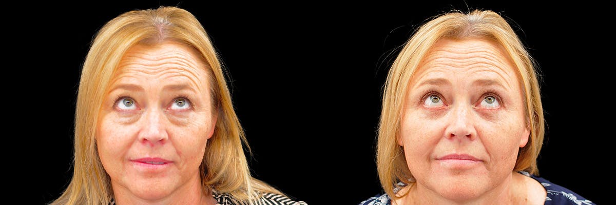 Blepharoplasty (Eyelid Surgery) Before & After Gallery - Patient 889458 - Image 2