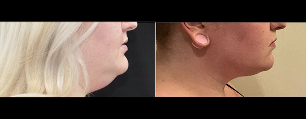 Neck Lift - Neck Vaser Lipo Before & After Gallery - Patient 931237 - Image 1