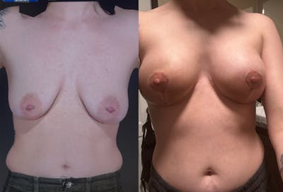Breast Augmentation Before & After Gallery - Patient 200613 - Image 1