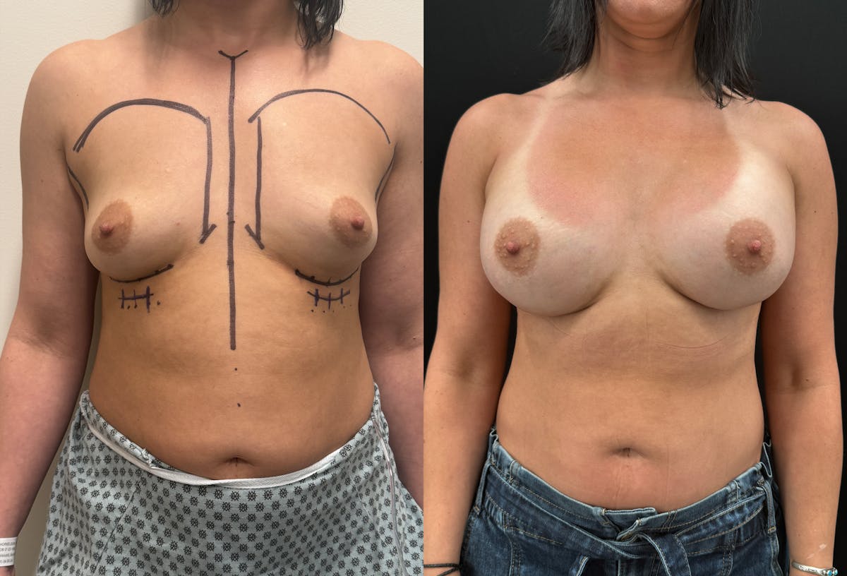Breast Augmentation Before & After Gallery - Patient 116215 - Image 1