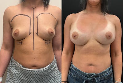 Breast Augmentation Before & After Gallery - Patient 116215 - Image 1