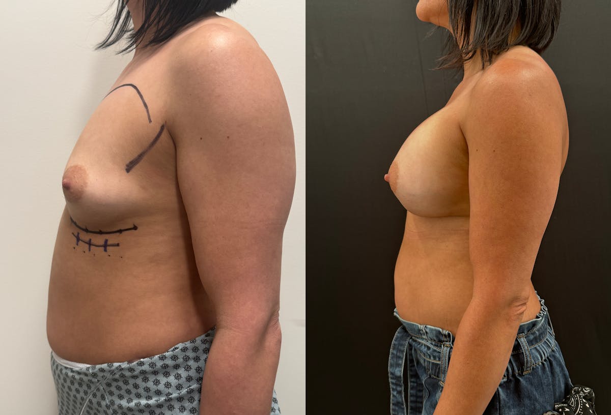Breast Augmentation Before & After Gallery - Patient 116215 - Image 2