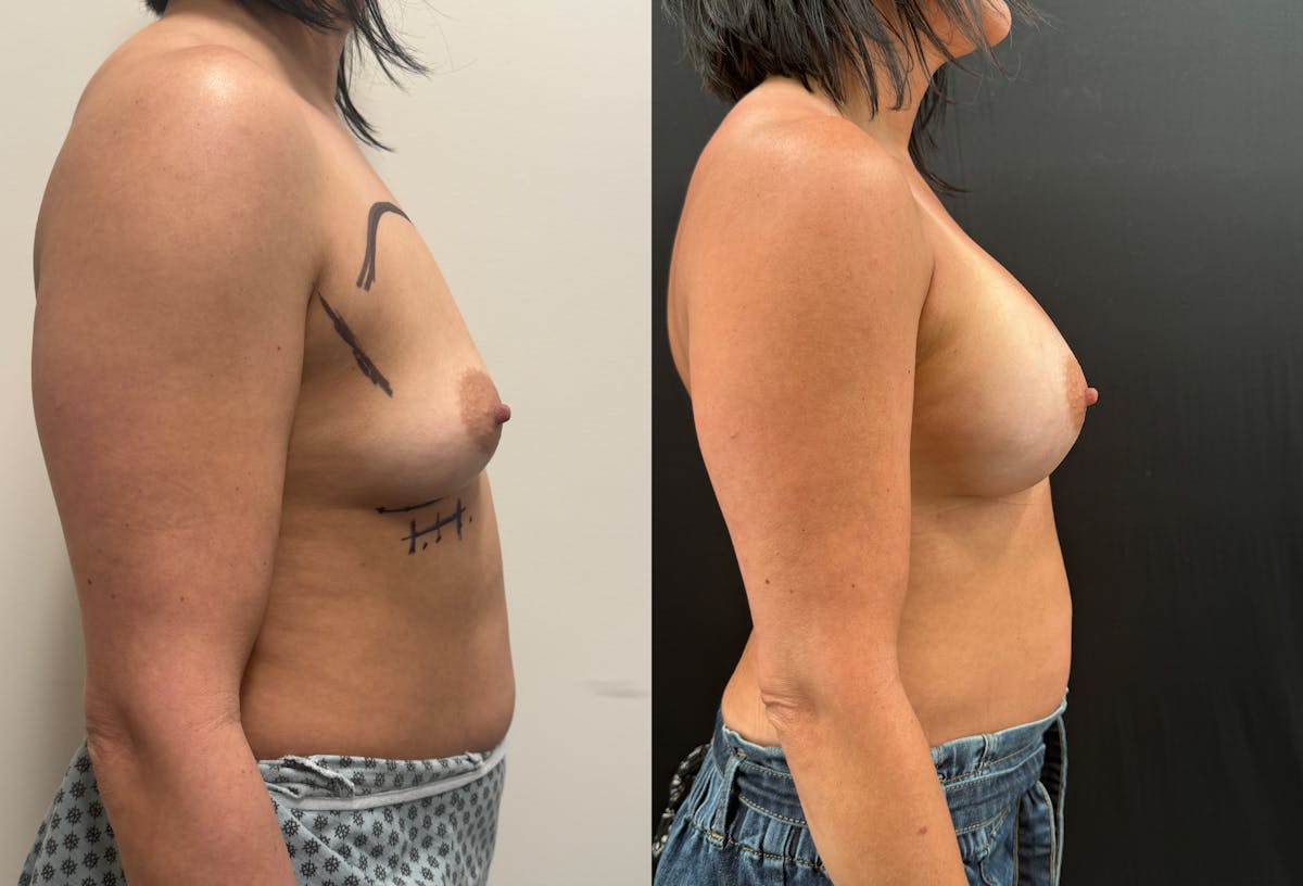 Breast Augmentation Before & After Gallery - Patient 116215 - Image 3