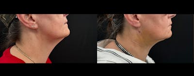 Neck Lift - Neck Vaser Lipo Before & After Gallery - Patient 130840 - Image 1