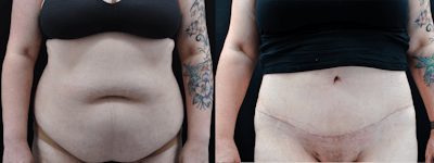 Abdominoplasty Before & After Gallery - Patient 323048 - Image 1