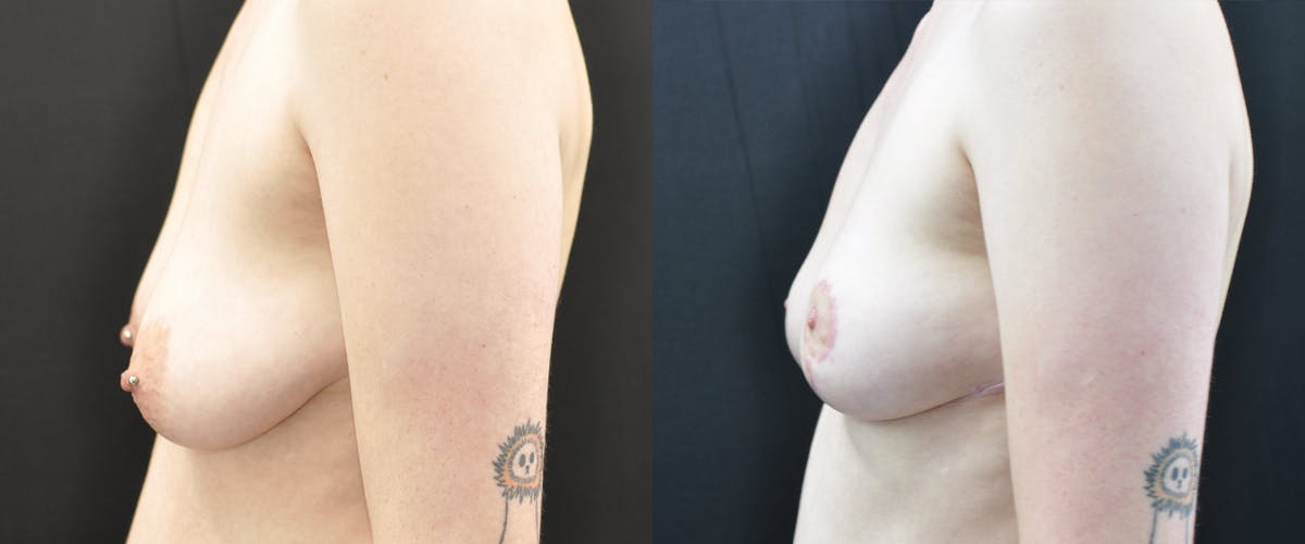 Breast Lift Before & After Gallery - Patient 449896 - Image 2