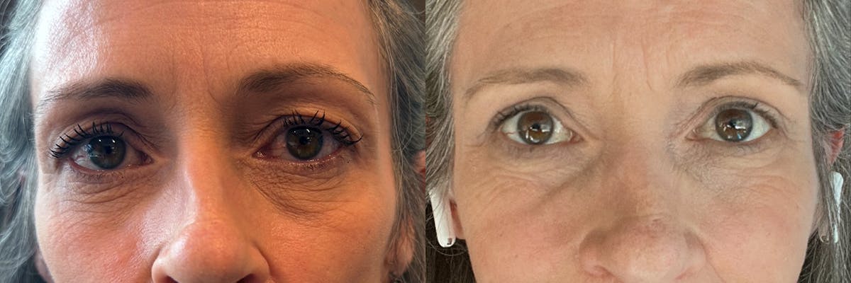 Blepharoplasty (Eyelid Surgery) Before & After Gallery - Patient 222982 - Image 1
