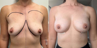 Breast Augmentation Before & After Gallery - Patient 408747 - Image 1
