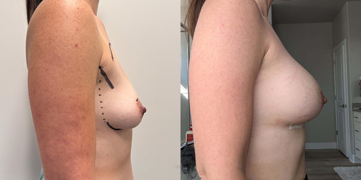Breast Augmentation Before & After Gallery - Patient 408747 - Image 2