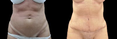 Abdominoplasty Before & After Gallery - Patient 270452 - Image 1