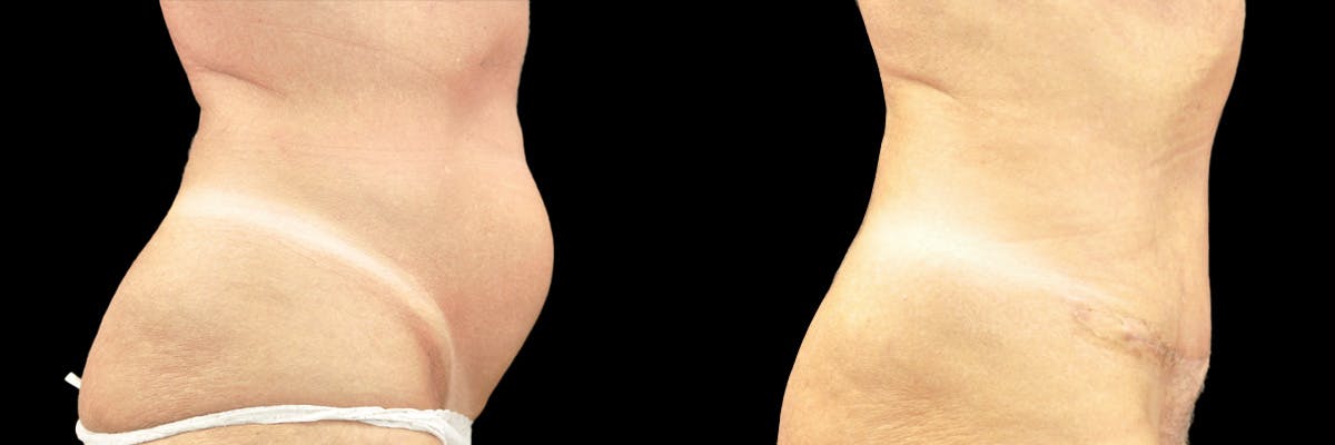 Abdominoplasty Before & After Gallery - Patient 270452 - Image 2