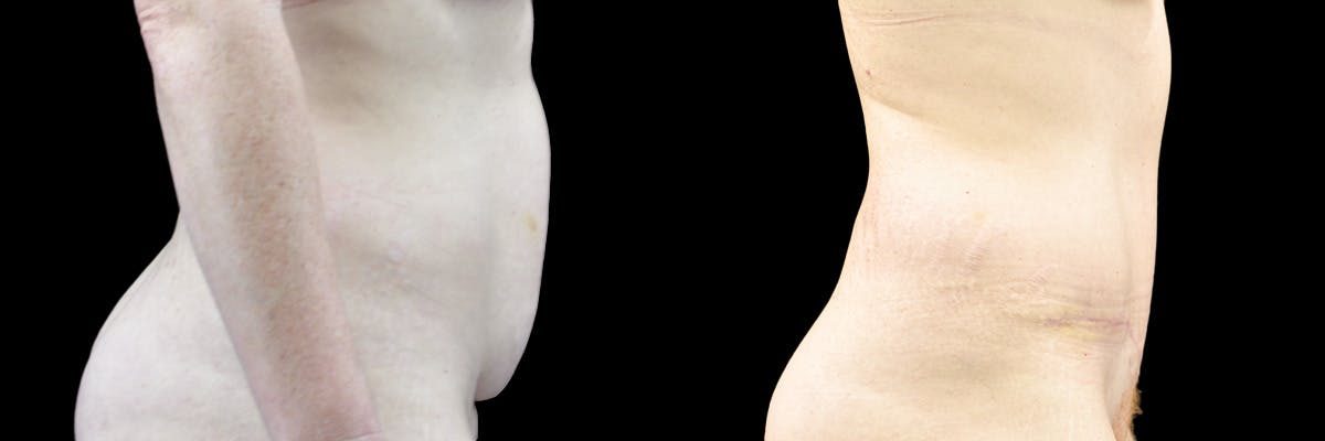 Abdominoplasty Before & After Gallery - Patient 299661 - Image 2