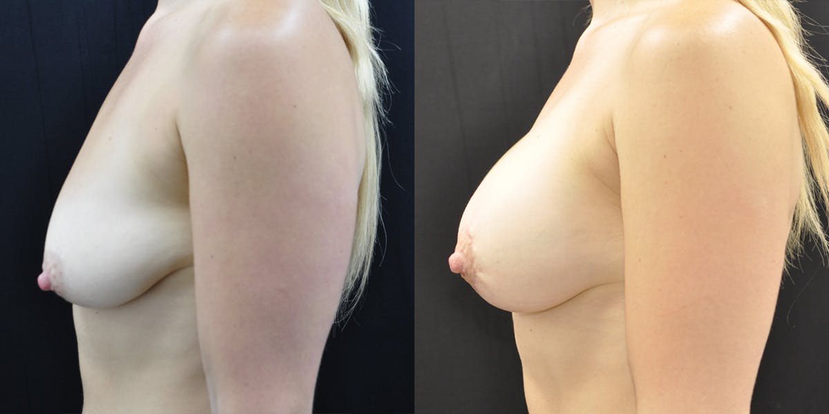 Breast Augmentation Before & After Gallery - Patient 389713 - Image 2