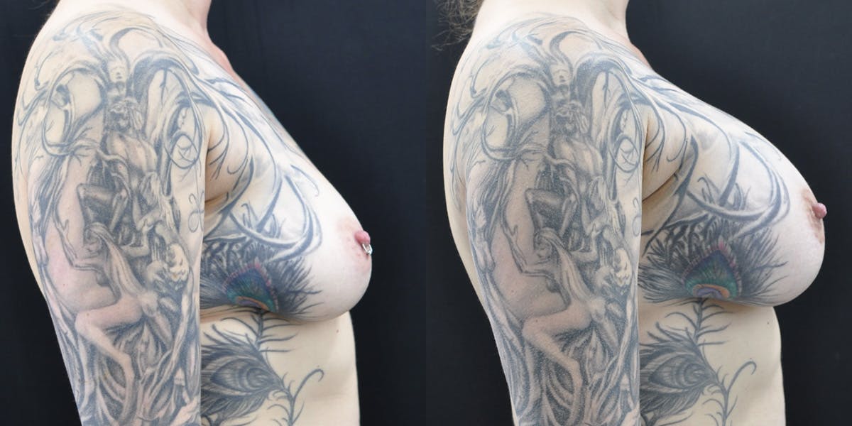 Breast Augmentation Before & After Gallery - Patient 301468 - Image 2