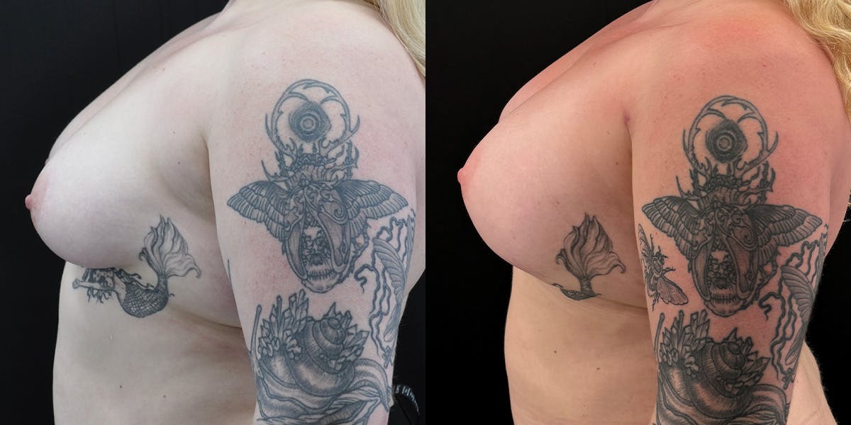 Liposuction Before & After Gallery - Patient 470461 - Image 1