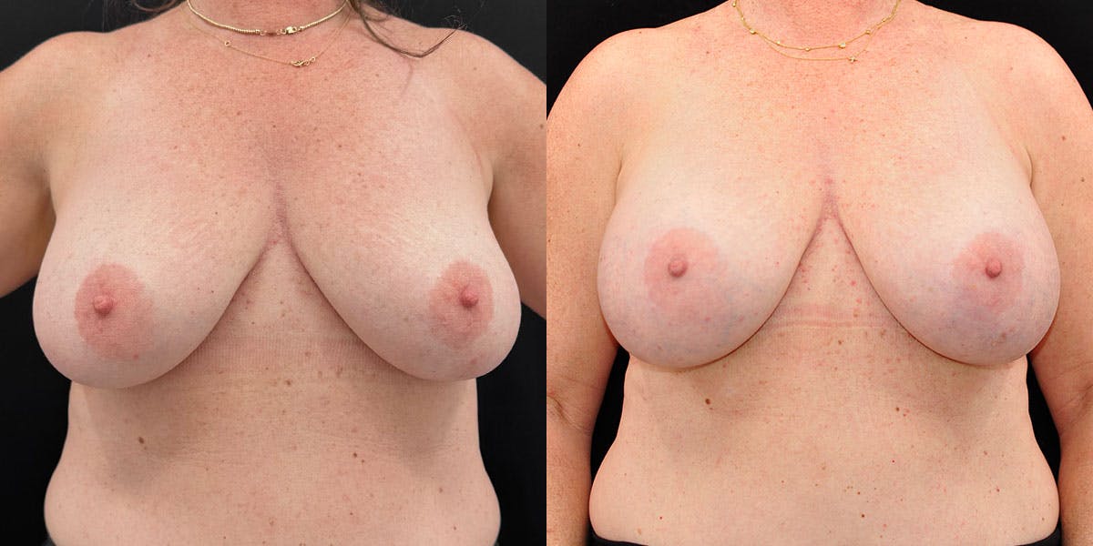 Breast Augmentation Before & After Gallery - Patient 330299 - Image 1