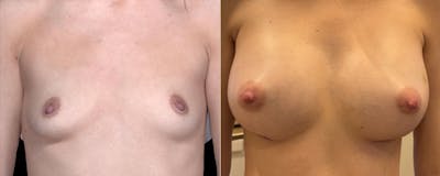 Breast Augmentation Before & After Gallery - Patient 198725 - Image 1