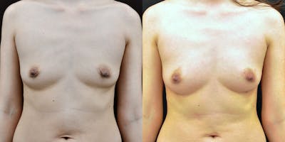 Fat Transfer/Fat Grafting Before & After Gallery - Patient 478381 - Image 1