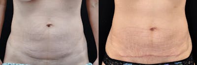 Liposuction Before & After Gallery - Patient 50245457 - Image 1