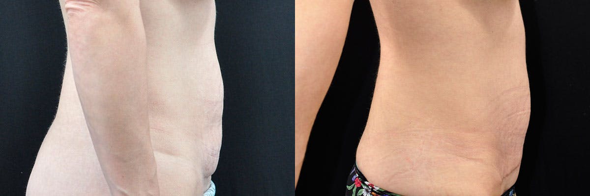 Abdominoplasty Before & After Gallery - Patient 305010 - Image 2