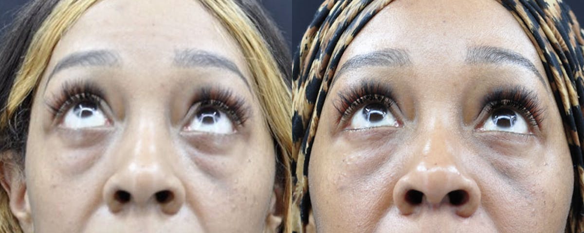 Blepharoplasty (Eyelid Surgery) Before & After Gallery - Patient 867127 - Image 2