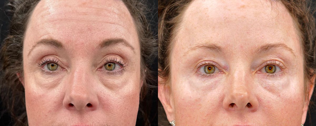 Blepharoplasty (Eyelid Surgery) Before & After Gallery - Patient 973421 - Image 1