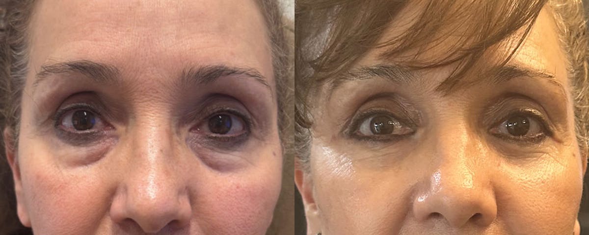 Blepharoplasty (Eyelid Surgery) Before & After Gallery - Patient 236026 - Image 1