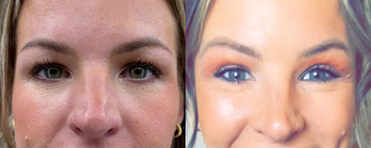 Blepharoplasty (Eyelid Surgery) Before & After Gallery - Patient 230239 - Image 1
