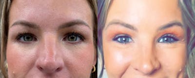 Blepharoplasty (Eyelid Surgery) Before & After Gallery - Patient 230239 - Image 1