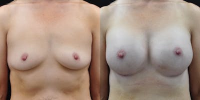 Breast Augmentation Before & After Gallery - Patient 148726 - Image 1