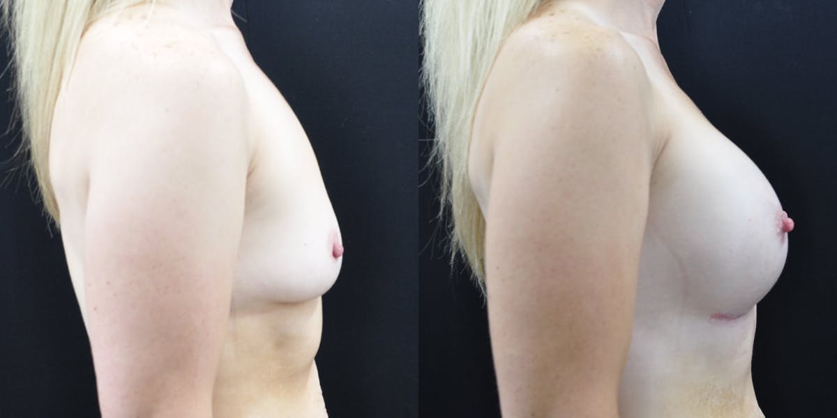 Breast Augmentation Before & After Gallery - Patient 148726 - Image 2