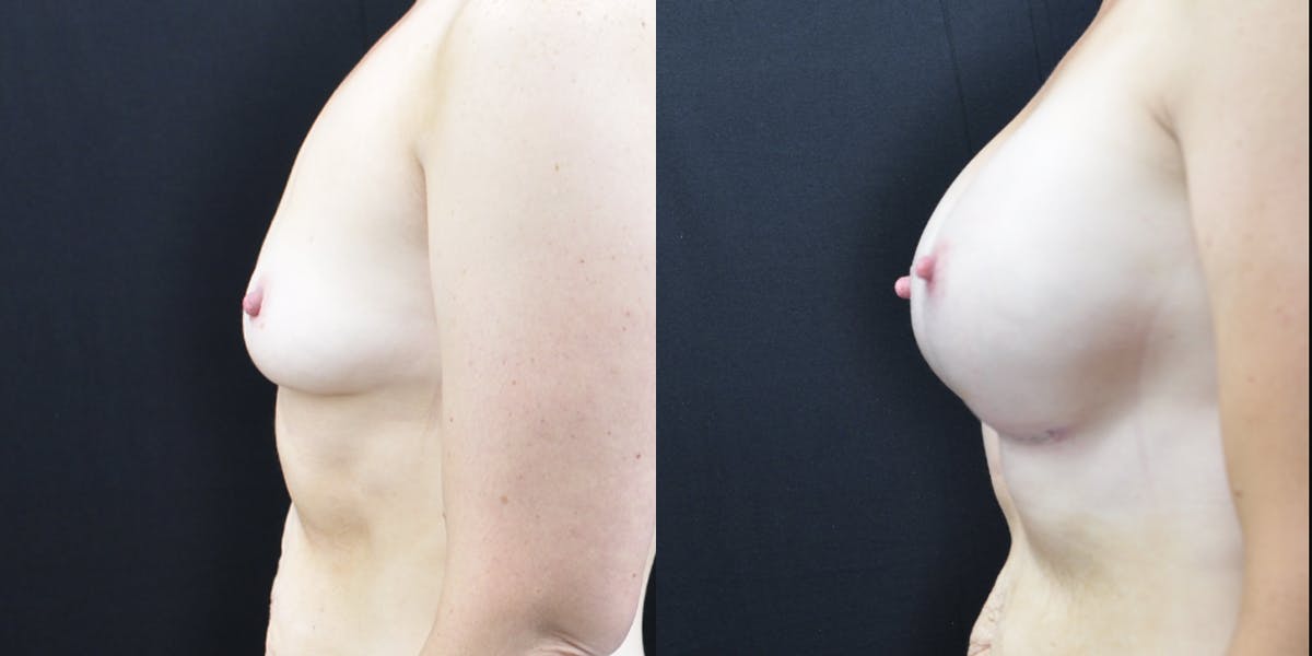 Breast Augmentation Before & After Gallery - Patient 148726 - Image 3
