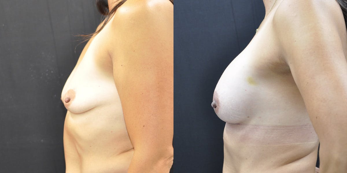 Breast Augmentation Before & After Gallery - Patient 116254 - Image 2