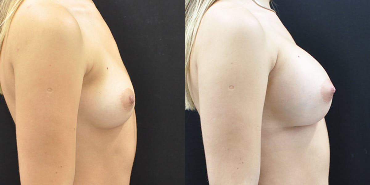 Breast Augmentation Before & After Gallery - Patient 283714 - Image 2