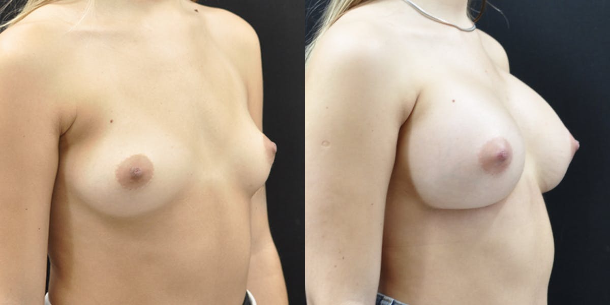Breast Augmentation Before & After Gallery - Patient 283714 - Image 3