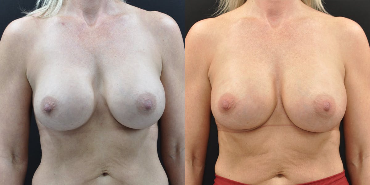Implant Exchange Before & After Gallery - Patient 259442 - Image 1