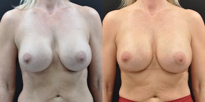 Implant Exchange Before & After Gallery - Patient 259442 - Image 1