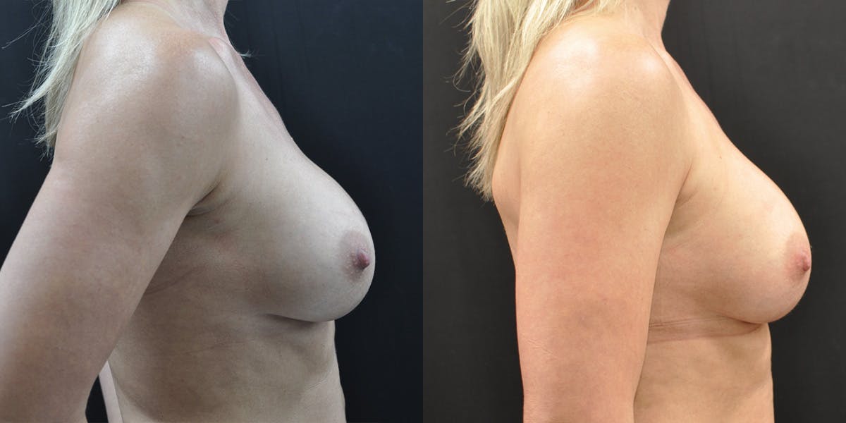 Implant Exchange Before & After Gallery - Patient 259442 - Image 3