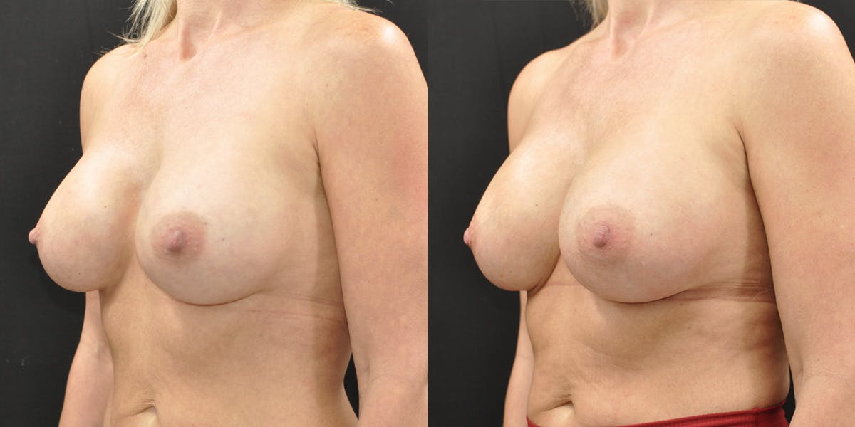 Implant Exchange Before & After Gallery - Patient 259442 - Image 4